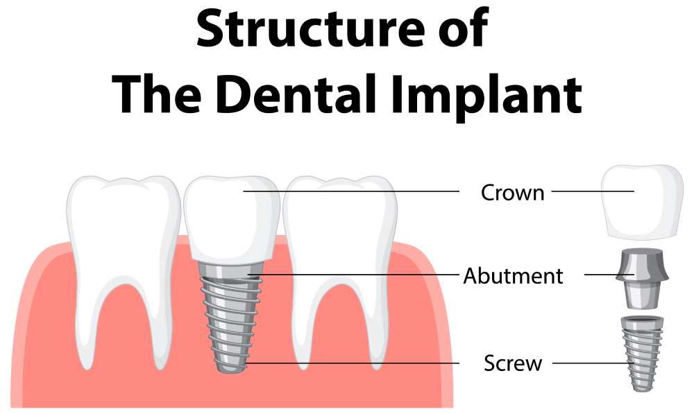 dental-implant