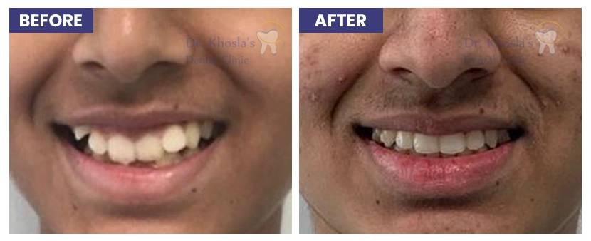 Invisalign Treatment in Delhi