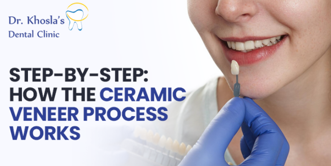 Ceramic Veneer Ceramic Veneer