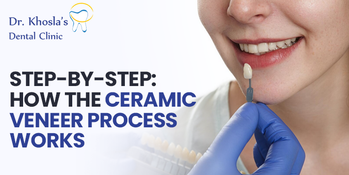 Ceramic Veneer Ceramic Veneer
