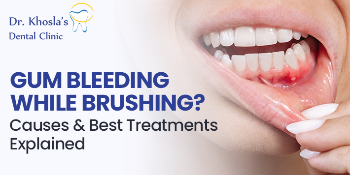 gum bleeding causes treatment gum bleeding causes treatment