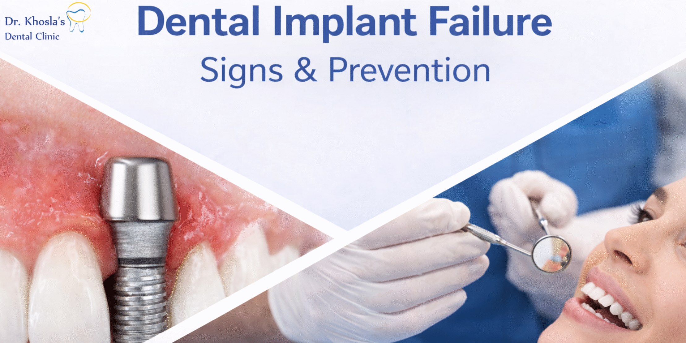 dental implant failure dental implant failure